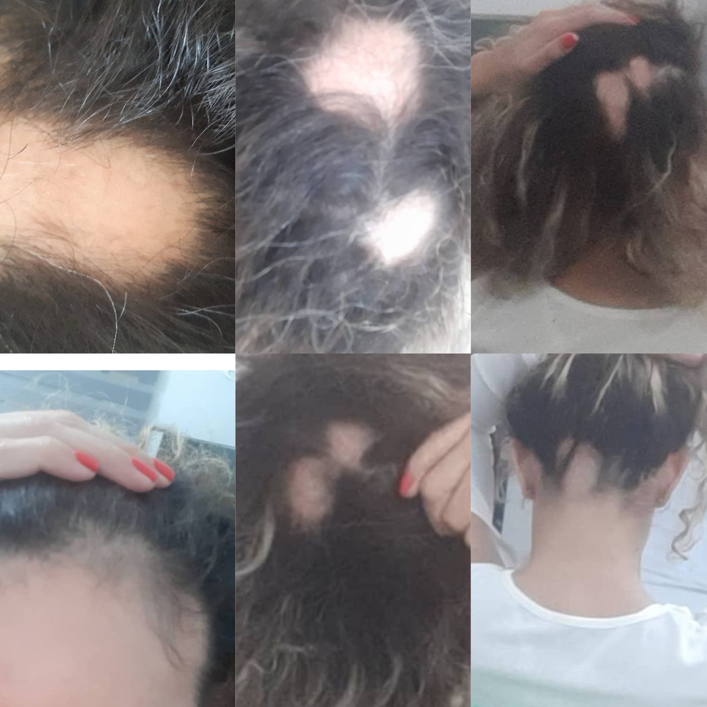 Varias vistas de parches de alopecia areata en distintas zonas de la cabeza
