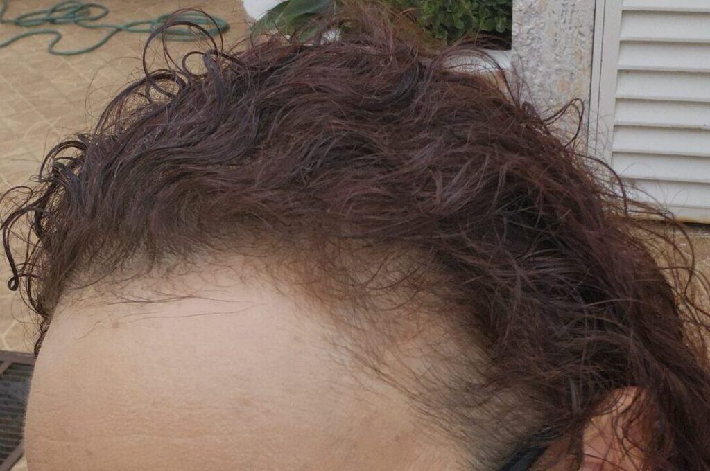 Línea frontal del cabello con pérdida de densidad
